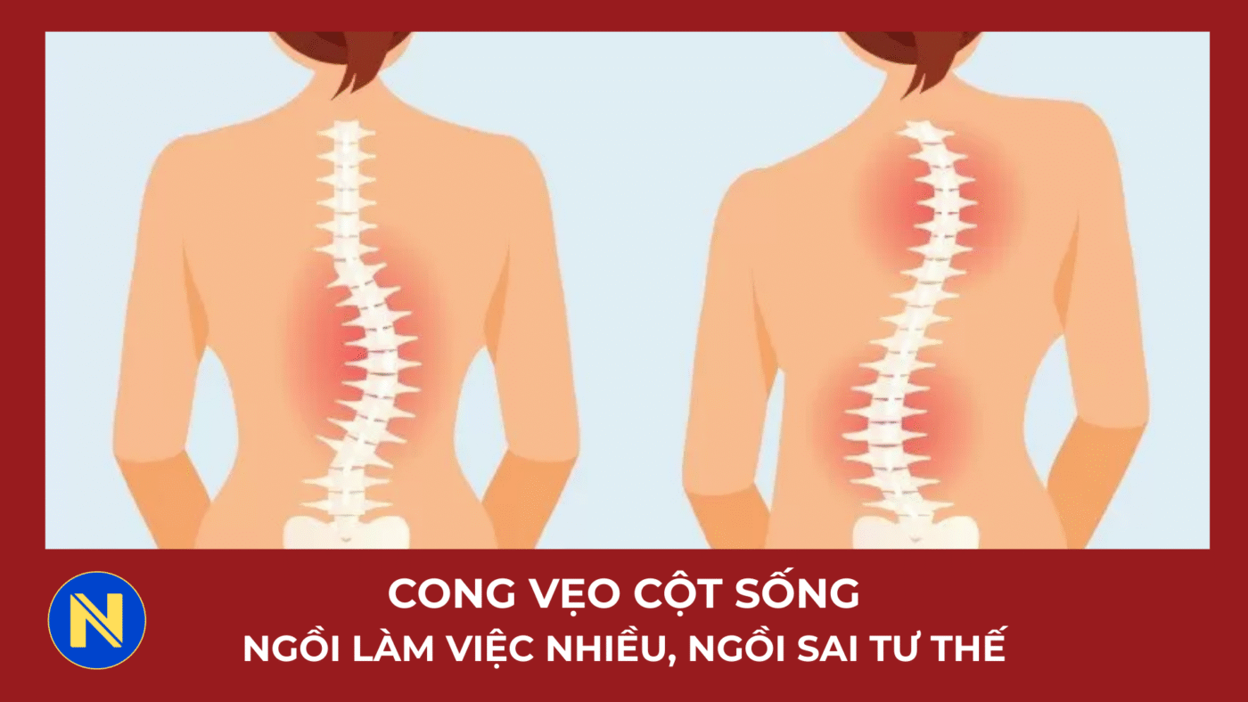 NGUYÊN NHÂN CONG VẸO CỘT SỐNG